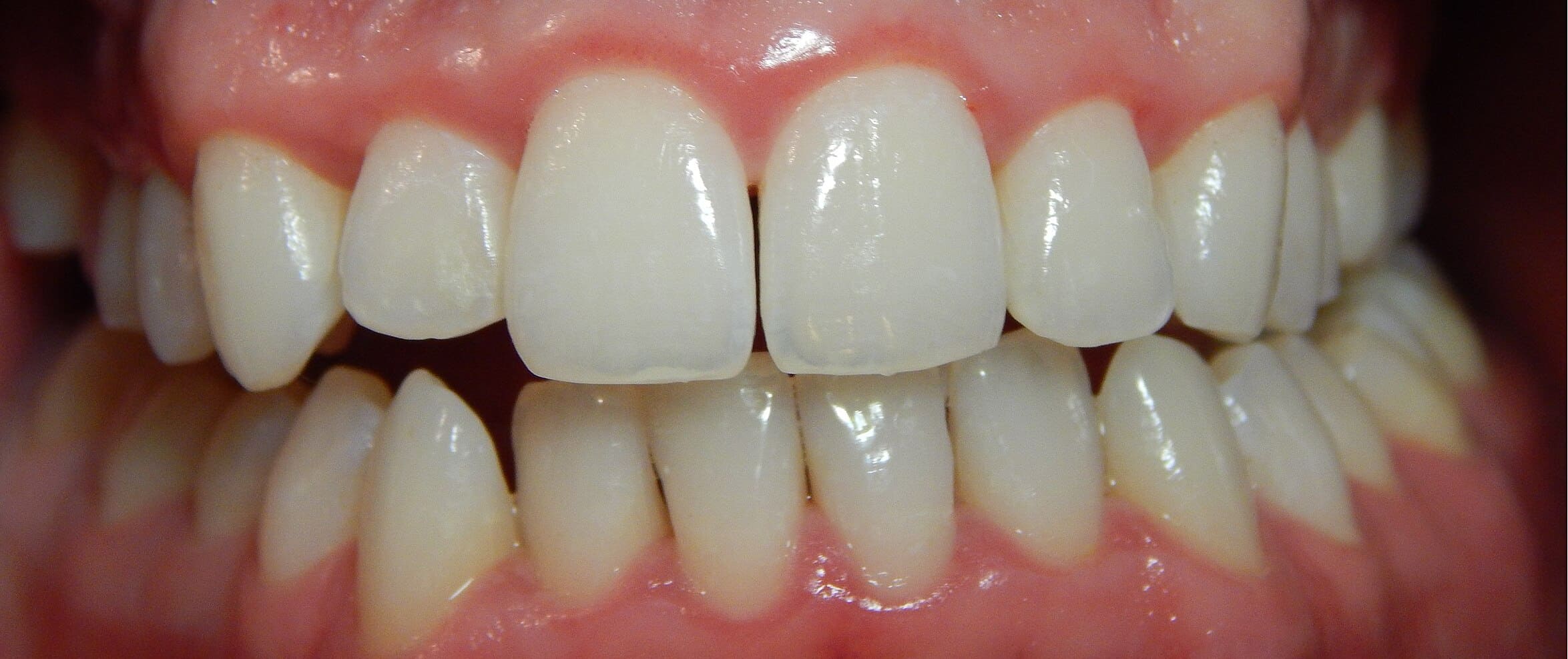 healthy teeth with no plaque and gingivitis